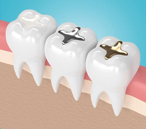 Torrance Composite Fillings