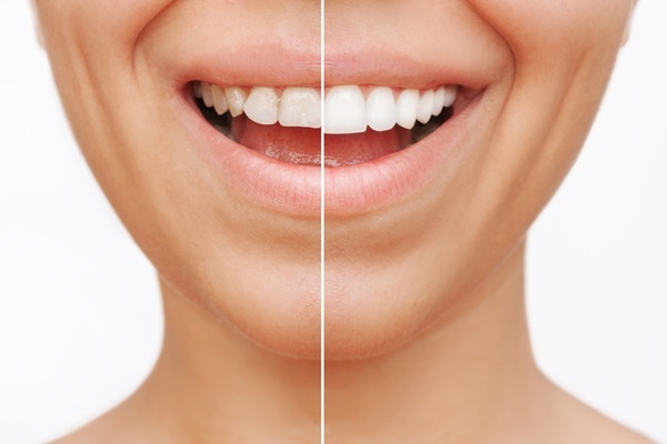 Improve Your Smile With Cosmetic Dentistry