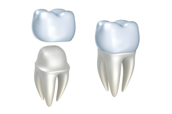 dental implants Torrance, CA