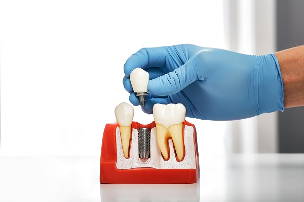 Dental Implants: Long Term Tooth Replacement Solution