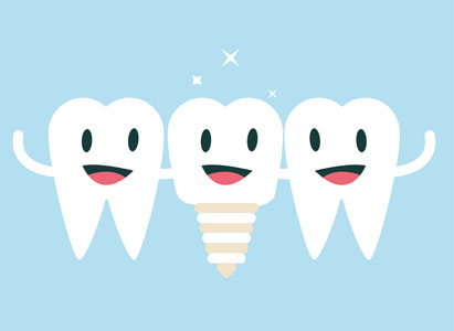 The Process Of Getting Dental Implants