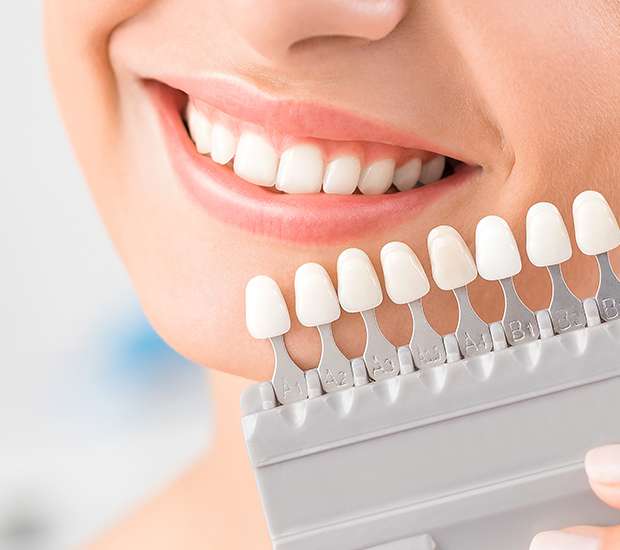 Torrance Dental Veneers and Dental Laminates