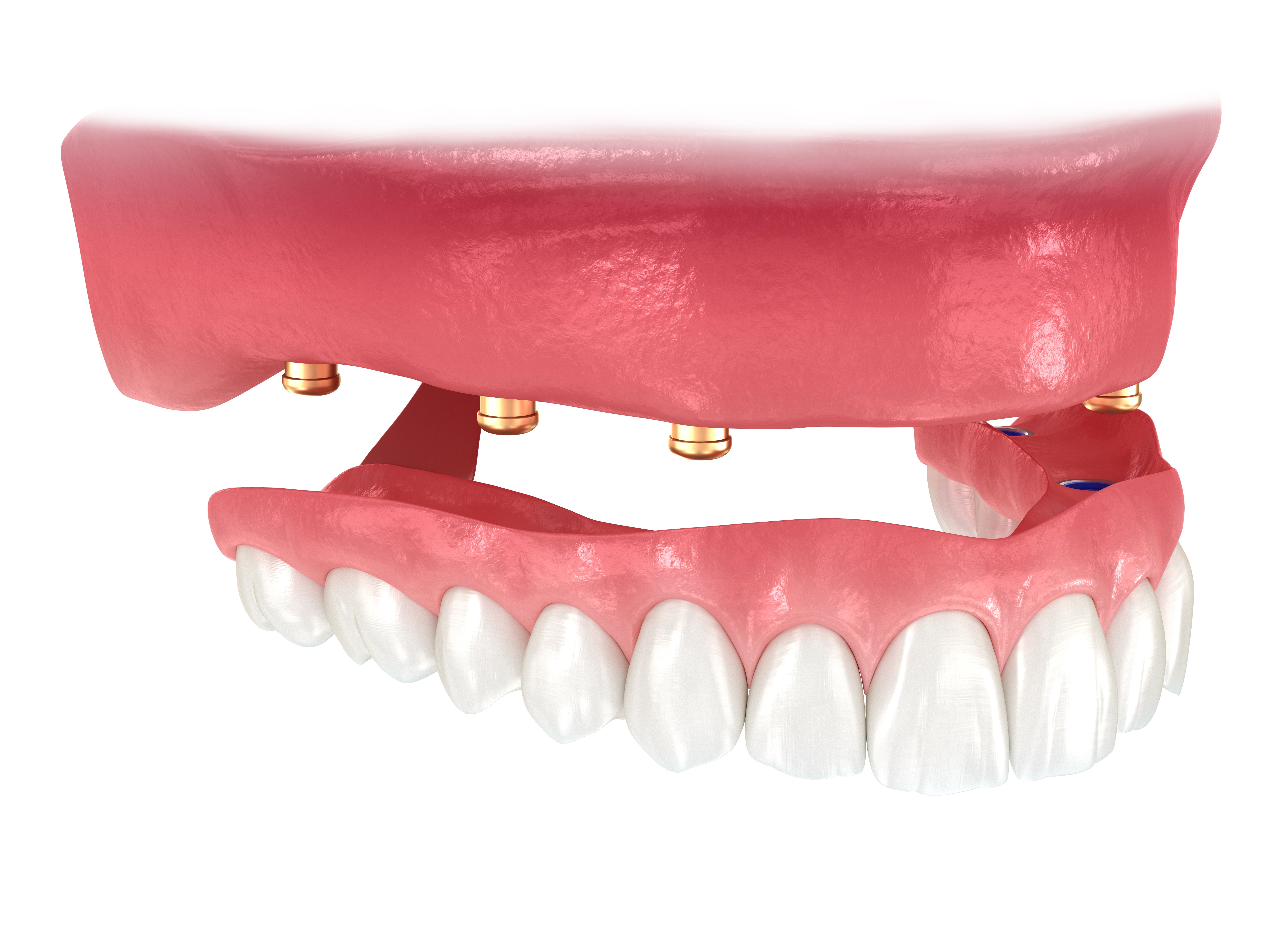 Implant Supported Dentures Can Solve The Problem Of Missing Teeth