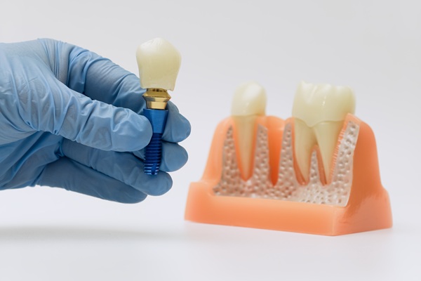 How Soon Can You Get Tooth Implants  After Extraction?