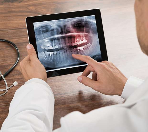 Torrance Types of Dental Root Fractures